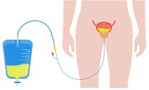 urine tube Insertion